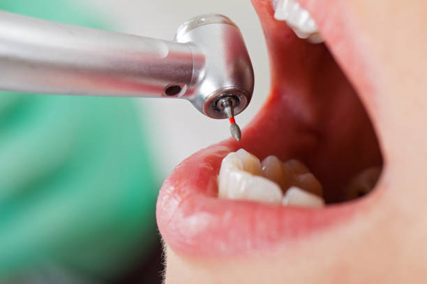 Best Broken or Cracked Tooth Emergency Dentist in Landen, OH